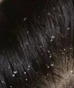 Шампоан против пърхот Kadiffe Anti-Dandruff - Image 3
