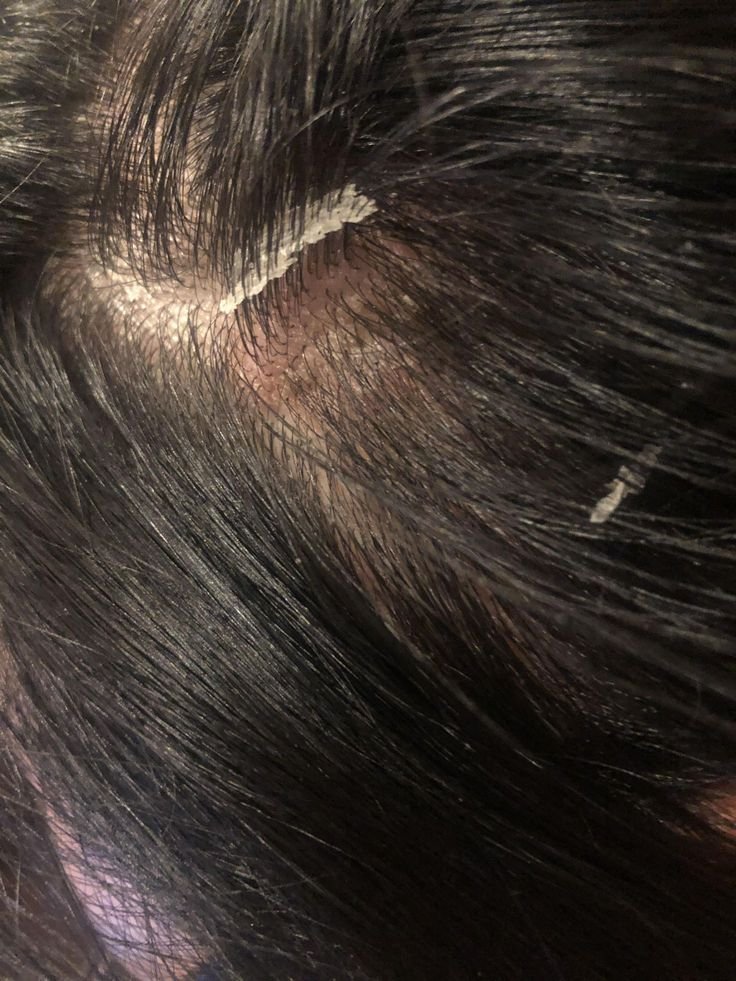 Дълбокопочистващ шампоан при мазна себорея Маска с кокосово масло за скалп със себореен дерматит AHA/BHA киселини за почистване на скалпа Съвети за грижа при себорея